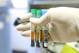 痛风复查别只盯尿酸，这几行才是关键